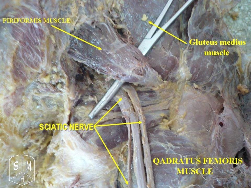 Siyatik sinirin bel ve kalça bölgesinden bacağa uzanan anatomik seyri